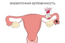 Внематочная беременность симптомы